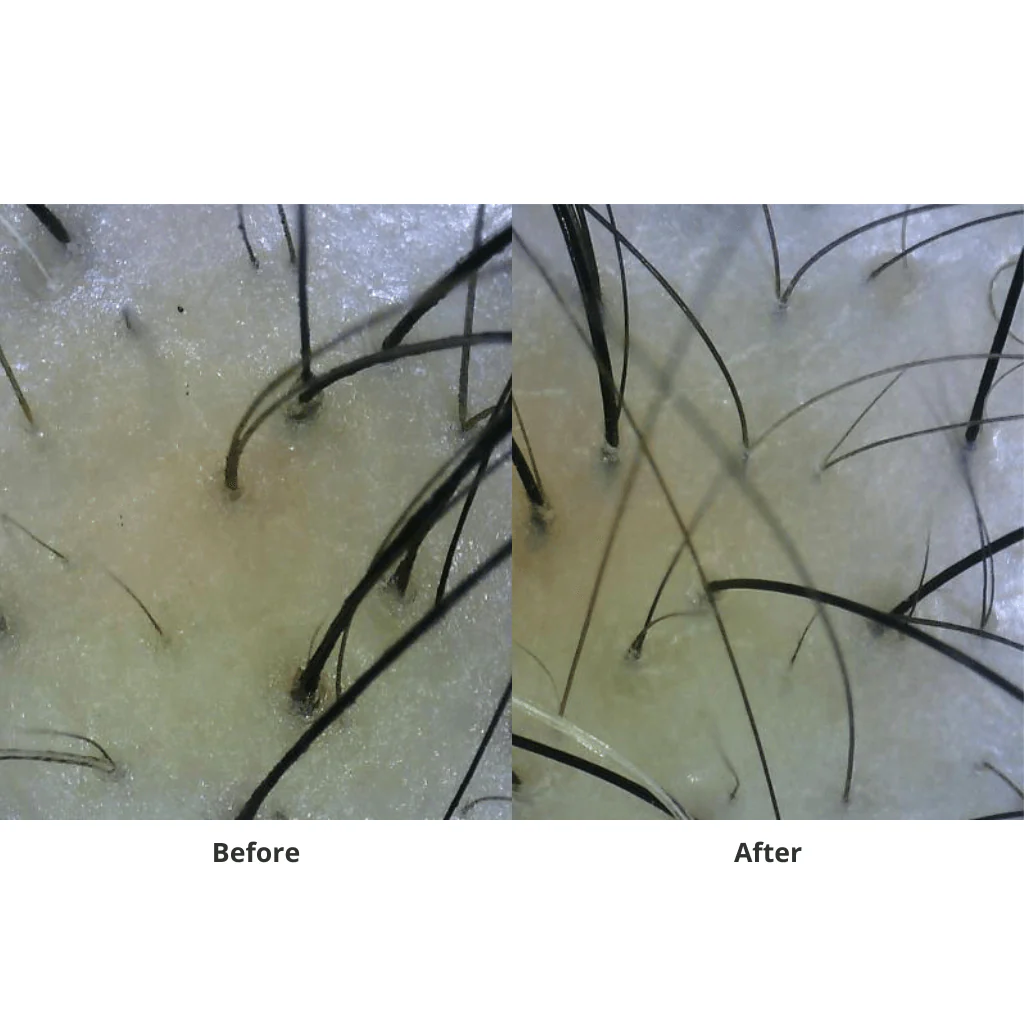 juliArt Hair Loss With Dry Scalp ECHO System - Image 2